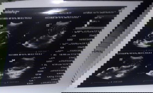 Plasenta masih di bawah