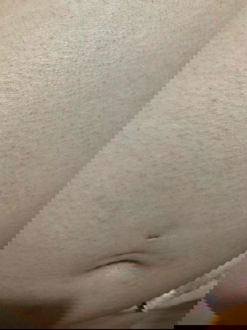 ผดผื่น!!อันตรายมั้ย???