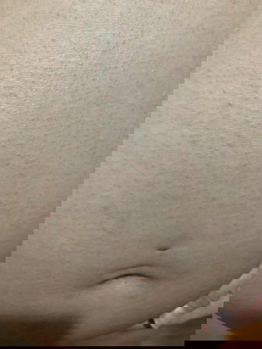 ผดผื่น!!อันตรายมั้ย???