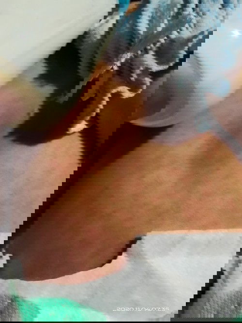 Bintik merah pada bayi