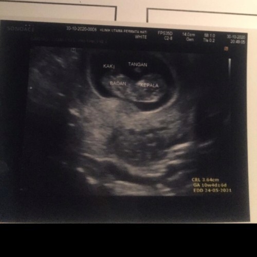 Kenapa usia janin di app sama dokter berbeda