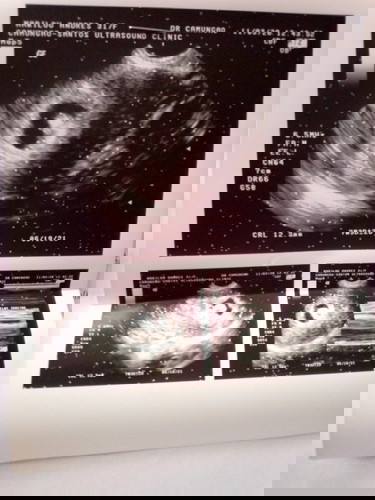 Is there a heartbit of 5weeks pregnant?