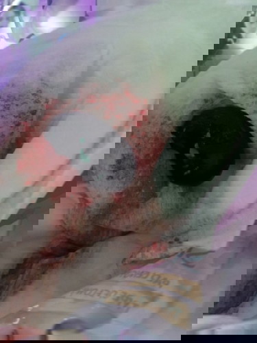 Blood clot po ba to?