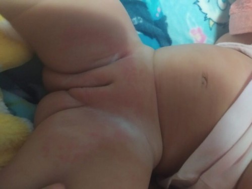 กังวลกัวจะเเพ้เเพมเพิส