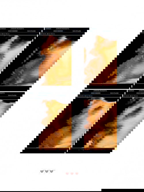 Air ketuban keruh, sedikit, dan sungsang.