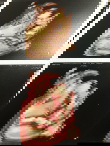 อายุครรภ์15สัปดาห์3วัน เจอภาวะรกเกาะต่ำ