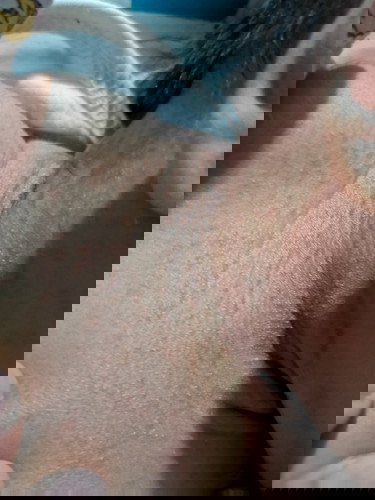 Rashes paano po ito gamotin?