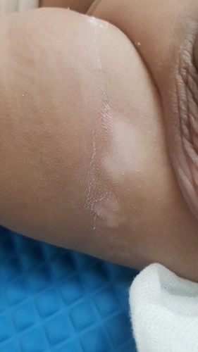 Rashes in Bum area