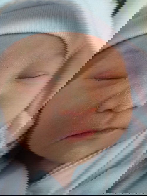 whitec sa mukha ni baby