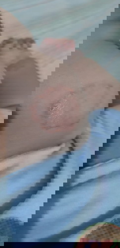 Ano pong pwdeng ilagay dito sa cheeks ng baby ko?