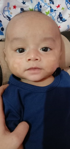 Bercak putih bukan alergi tapi