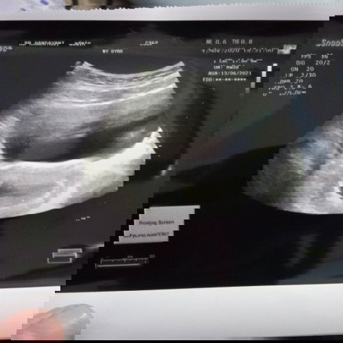 Hamil 8weeks keluar bercak