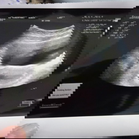 Hamil 8weeks keluar bercak