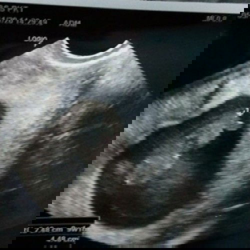 Detak jantung bayi belum terdeteksi