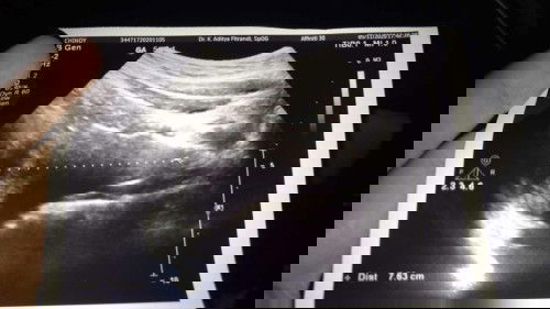 Belum terlihat kantung kehamilan