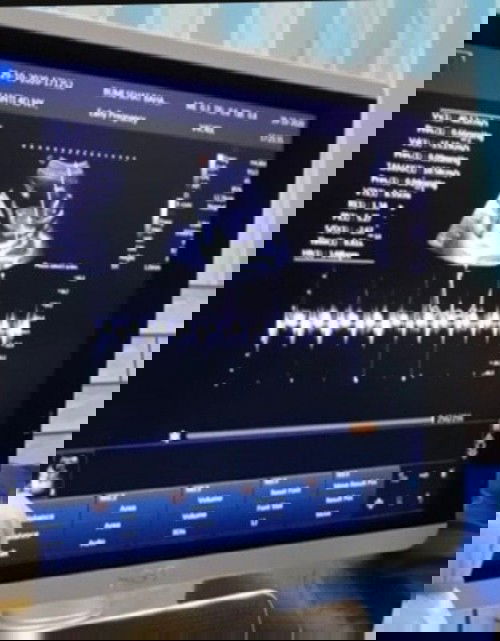 2x mengalami keguguran... Sempat trpuruk smpai akhir ny allah ksh hadiah terindah dgn kehamilan ini