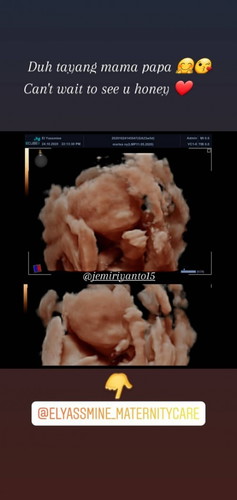 Melahirkan pakai BPJS