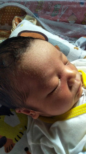 Bunda,Mau tanya.apkh baby bunda ada yg mengalami kringet buntet?Kalau ada bgmn cara mengatatasinya?