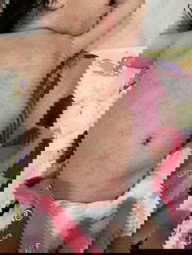 Rashes after Fever