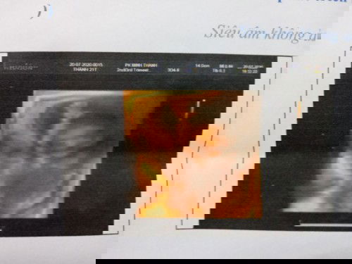 E bầu dc 8 thang oy.mà e ho quá cơ cac mom ạ.không bit có ảnh hưởng gi tới e bé k ạ