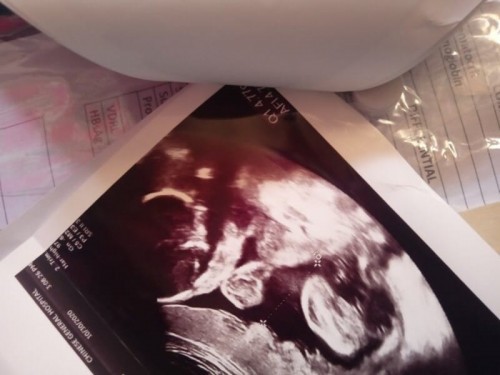 mismong si baby na po yan diba? Ulo, kamay at paa pero bat po parang ang payat po ng katawan?Thanks