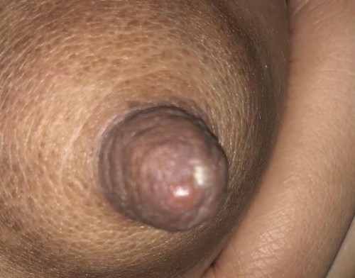 Parang Nana na dry at paltos sa nipple. At masakit sya.
