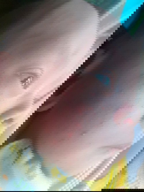 pipi beruntusan 😔