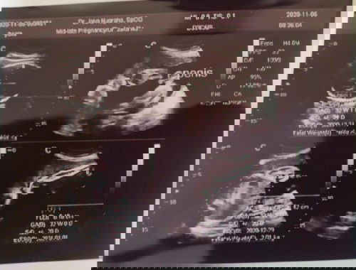 UK 31w bayi udah masuk panggul