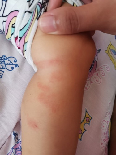 Baby rashes