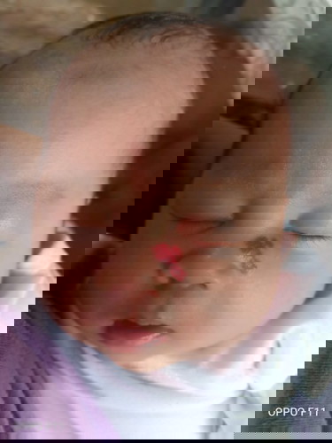 birthmarks?