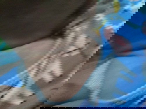 Bercak putih pada kulit bayi