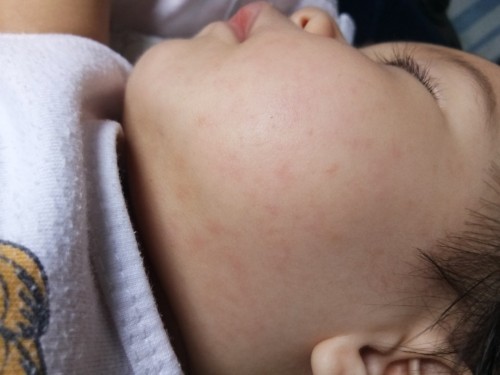 Rashes po ba?