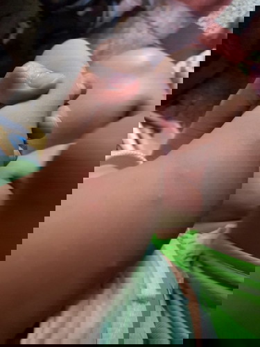 Insect bites