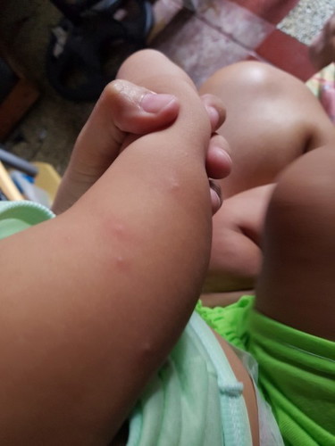 Insect bites