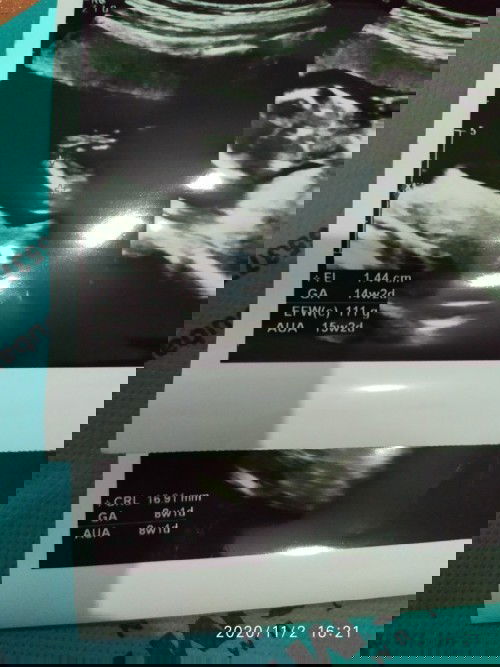 Bun knpa ya usia janin berubah setelah USG lagi?