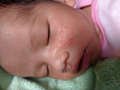 แก้มลูกขึ้นผื่น