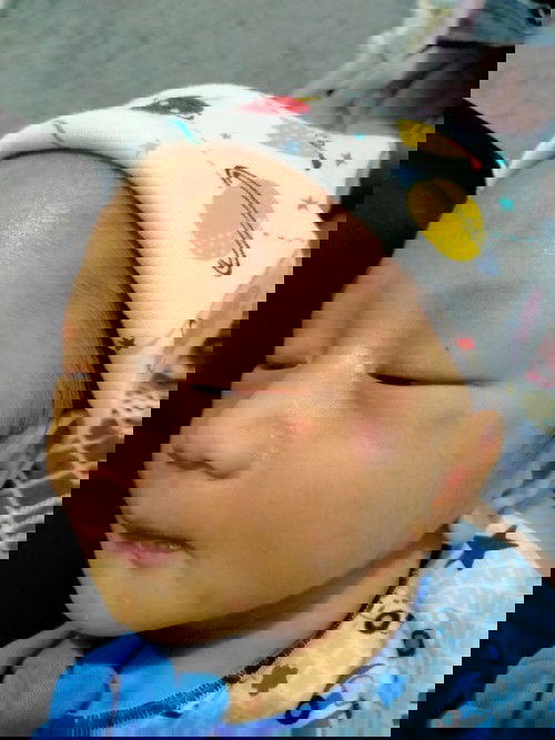 Merah merah pada kulit bayi