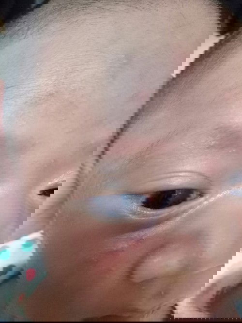 jerawat bayi 15 hari