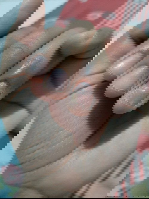 Kuku Jari manis rusak