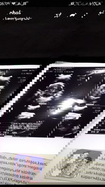 ketuban polihidramnion