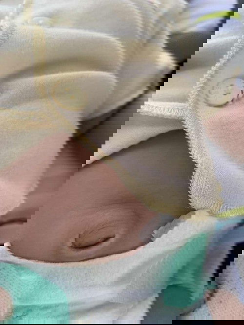 Anak sya usia 1 bulan 18 hri apakah normal bila pusarnya menonjol dan kadang mengeluarkan cairan ?mohon infonya ?🙏