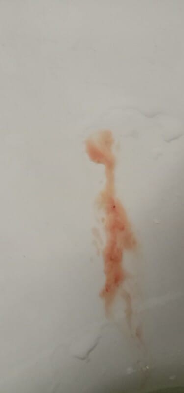 ตอนนี้กังวลมากค่ะกลัวแท้งมีโอกาสที่จะเกี่ยวกับที่แม่เป็นซึมเศร้าด้วยรึป่าวคะ