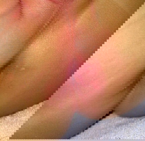 Sehabis diare muncul ruam