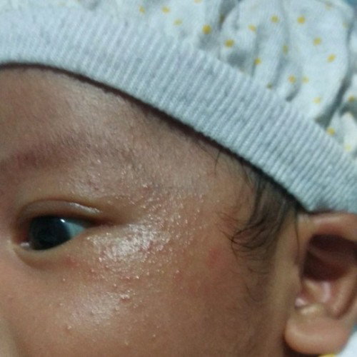 Bun ada yang samaan gak kulit muka bayinya kaya gini?