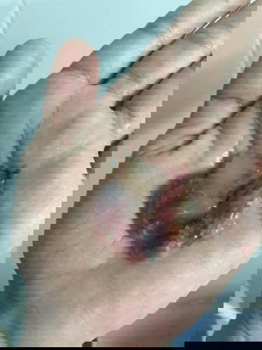 มีเลือดออกแบบนี้อันตรายไหมคะ