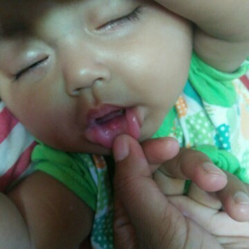 Bibir bayi