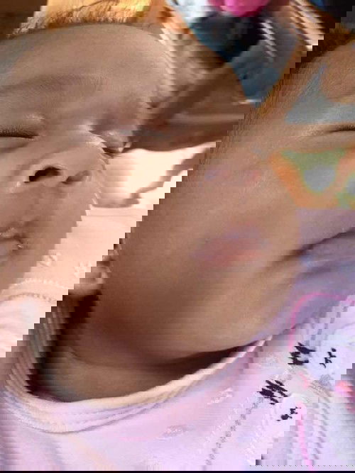 White spot on babt face and neck