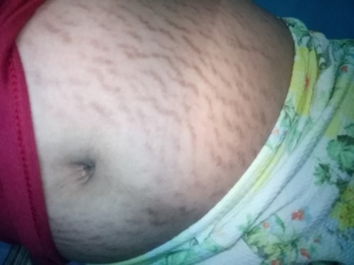 ask lang po ano pong pwedeng gamitin pangtanggal dyaan 😥 35weeks and 1day na tyan ko 😌