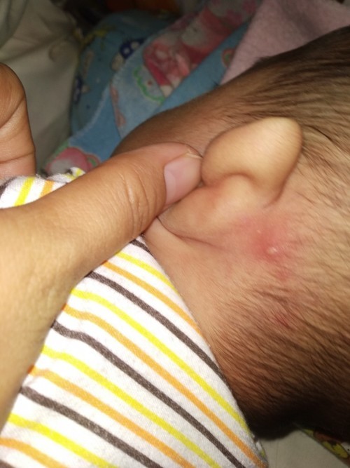 jerawat/bisul di kepala anak