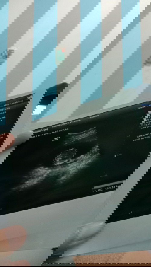 Usia kandungan sy 17W 2d bun... Tapi pass di usg usianya selisih seminggu . Apa seperti itu wajar ?